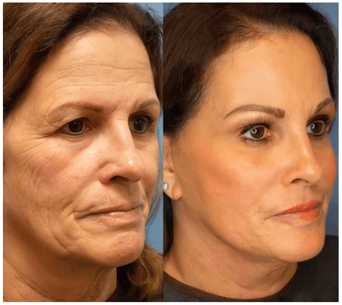 Antes e depois — rejuvenescimento