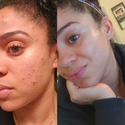 Antes e depois — acne e textura