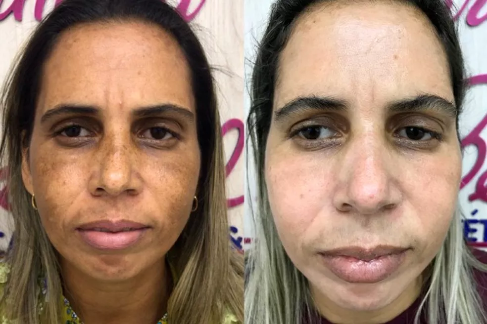 Antes e depois — manchas faciais